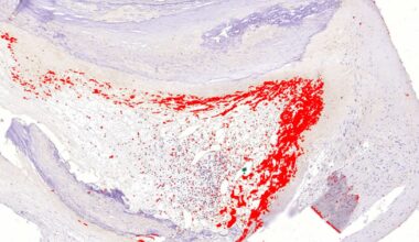 Histologinen kuva, jossa näkyy bakteeribiofilmi sepelvaltimon kolesterolia sisältävän ahtauman reunalla.