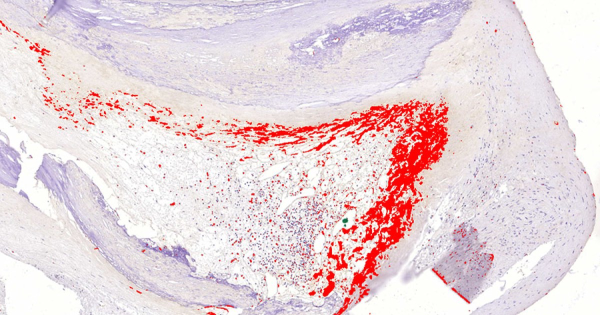 Histologinen kuva, jossa näkyy bakteeribiofilmi sepelvaltimon kolesterolia sisältävän ahtauman reunalla.