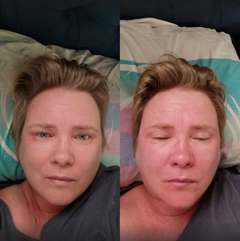 Huhtilainen taltioi myös ensimmäisellä sairasviikollaan ilmenneitä oireita blogiinsa. Sairauden kolmantena päivänä kasvoja alkoi kuumottaa ja punoittaa. Oire hävisi päivässä.