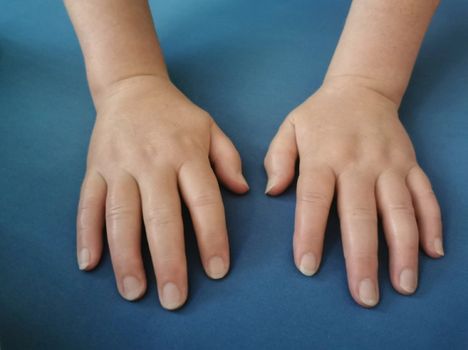 Huhtilaisen sormet turposivat taudin seurauksena niin paljon, ettei vihkisormus mahtunut nimettömään. Kuva otettu toukokuussa vajaa kaksi kuukautta sairauden alettua.