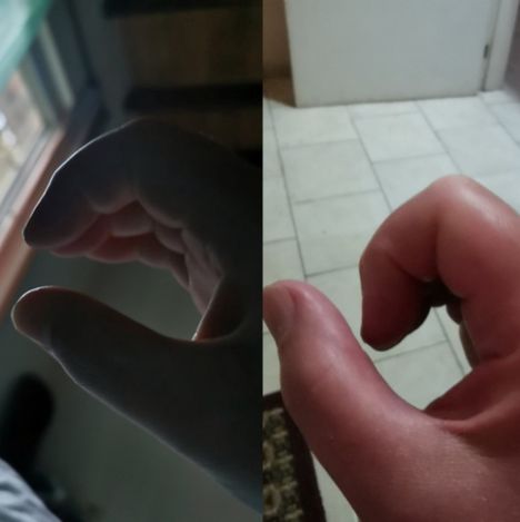 Huhtilainen ei pystynyt puristamaan myöskään käsiään nyrkkiin sairauden aikana. Kuvissa vertailukohtana aamun ja illan tilanne huhtikuussa 2023.