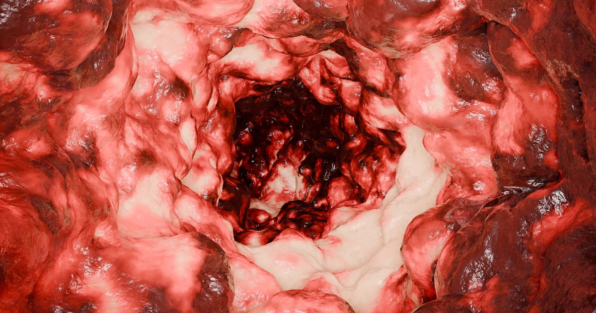 Aspiriini puolittaa suolistosyövän uusiutumisen riskin