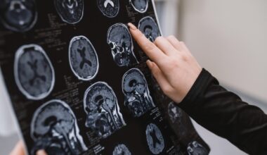 Espanjalaiset tutkijat löysivät uuden tien Alzheimerin taudin kääntämiseksi korjaamalla veri-aivoesteen (onnistui hiirillä). -