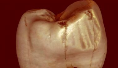 Muinaisihmisten hampaiden urat saivat uuden selityksen