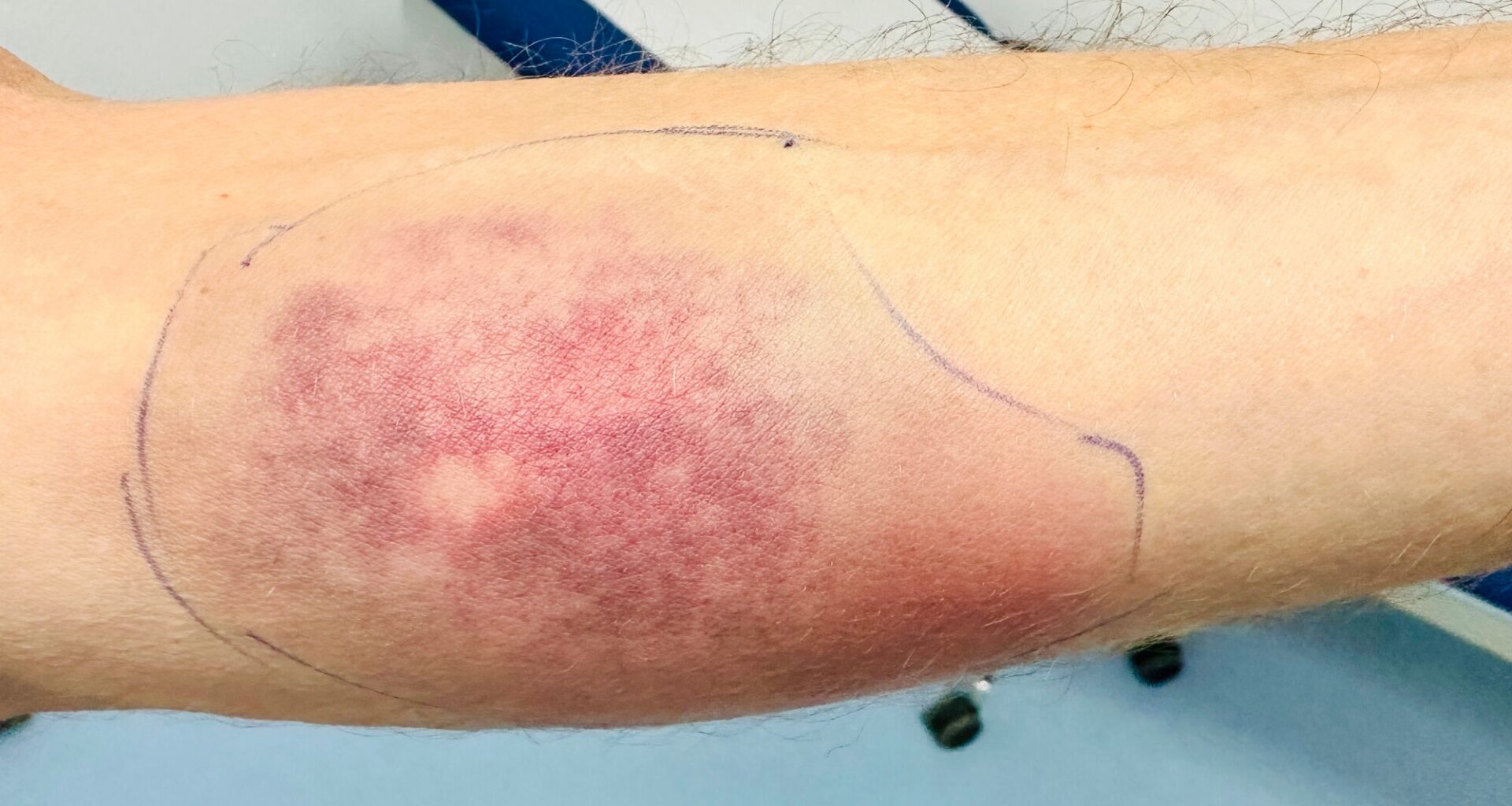 Sepsis vaarantaa hengen – Joskus ainoa oire on heikko yleistila