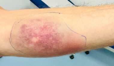 Sepsis vaarantaa hengen – Joskus ainoa oire on heikko yleistila