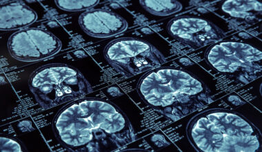 Kaksi piirrettä yhdistää "superikääntyjiä", jotka ovat skarppeja yli 80-vuotiaina