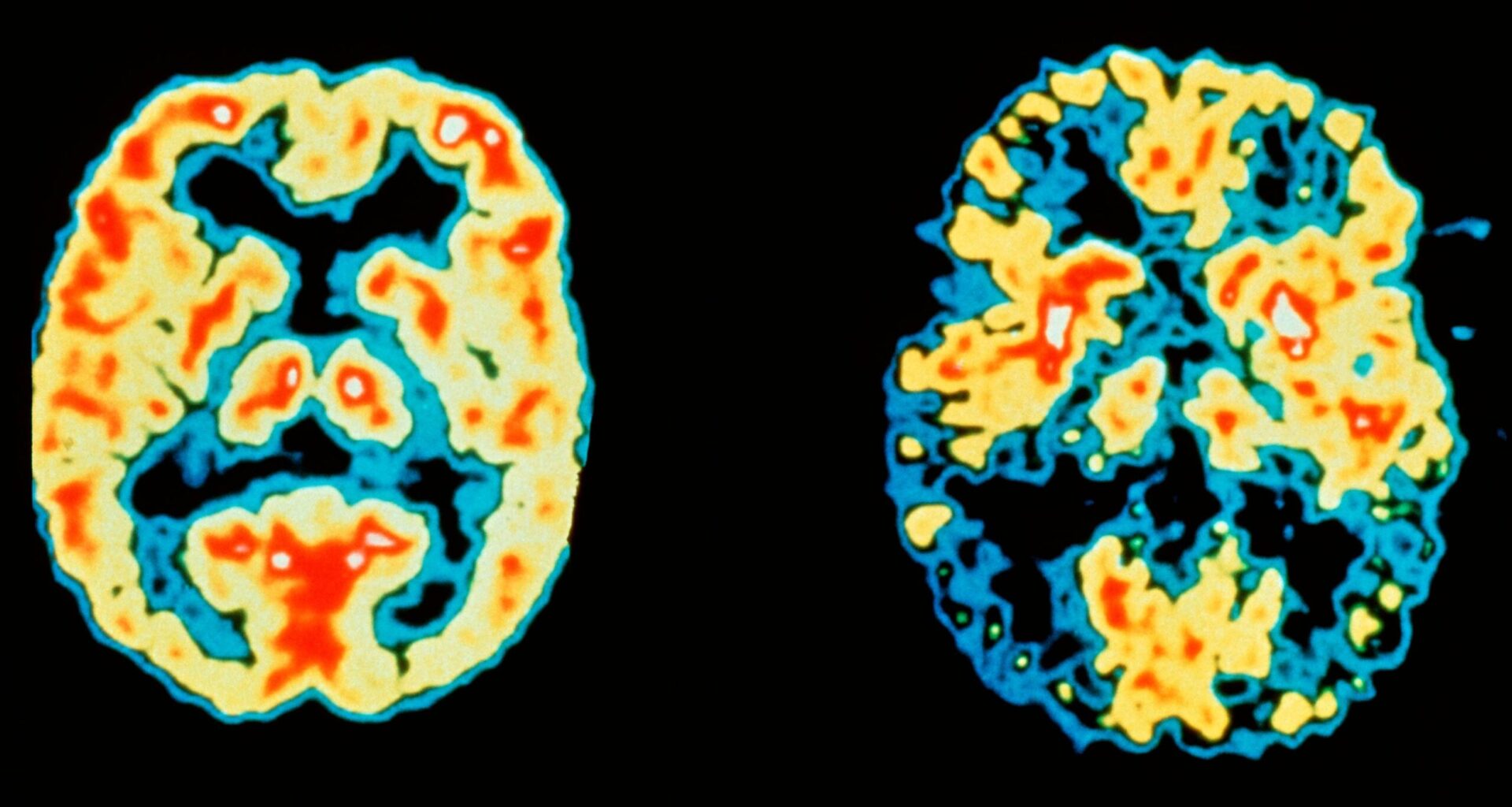 Näin Alzheimer paljastuu jo vuosia etukäteen – uusi testi muuttaa kaiken