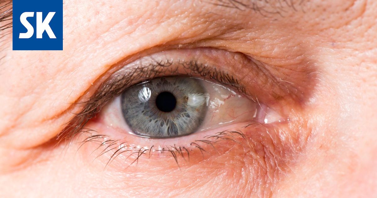 Silmän verkkokalvo paljastaa sairausriskejä ja vanhenemisen vauhdin