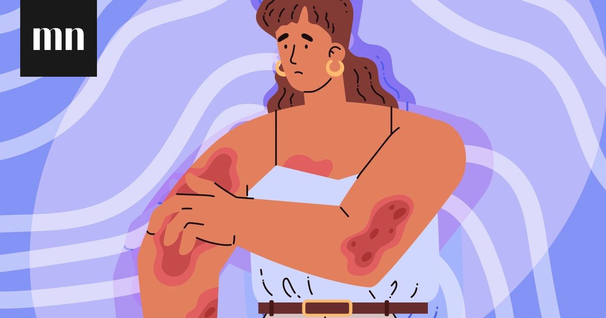 Harvinaiset stressioireet: näin monin tavoin stressi voi vaikuttaa kehoon