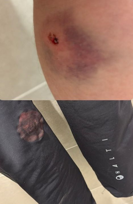 Keski-ikäisen mieshiihtäjän sauvan piikki teki pahaa jälkeä Mirjam Salomäen pohkeeseen ja jätti verisen muiston hiihtohousuihin. ”Nyt saa jännittää, mitä tämän jalan kanssa käy. Koska pääsee avantoon ja tuleeko tulehdusta.”