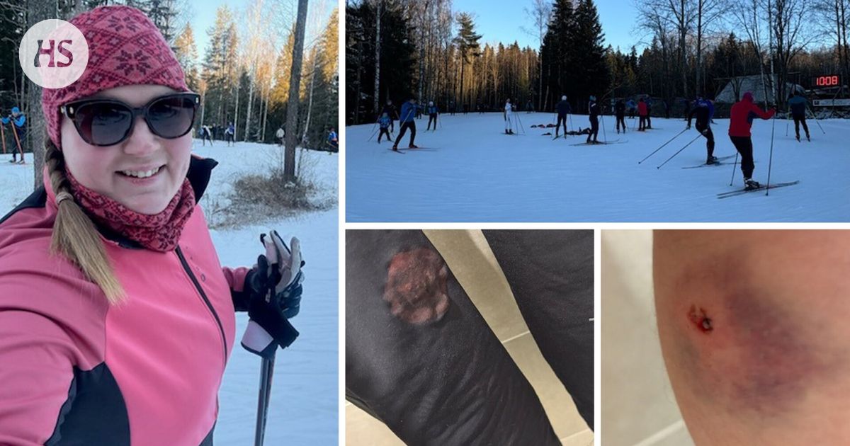 Mirjam Salomäki sai Oittaalla sauvanpiikistä pistohaavan: ”Ei minkäänlaista pahoittelua”