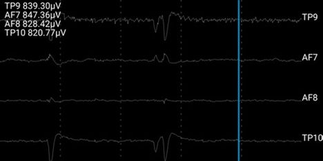 EEG-panta tallentaa aivojen sähköistä toimintaa useilla aaltoalueilla. Yksiköt ovat mikrovoltteja.