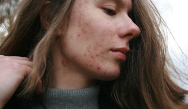 Aikuisiän akne vaivaa jopa kolmasosaa 35-vuotiaista suomalaisista naisista