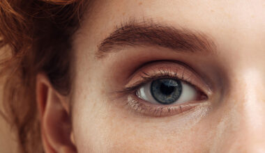 Mistä elohiiri silmässä johtuu? Nämä ovat yleisimmät syyt