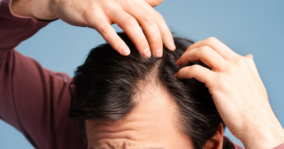 Tutkijat löysivät keinon käynnistää karvankasvu uudelleen