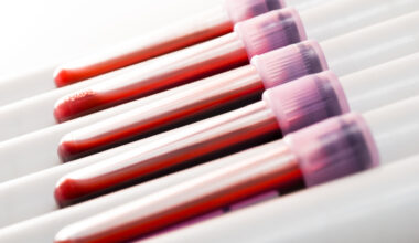 Kroonisen väsymysoireyhtymän voi nyt tunnistaa verikokeella