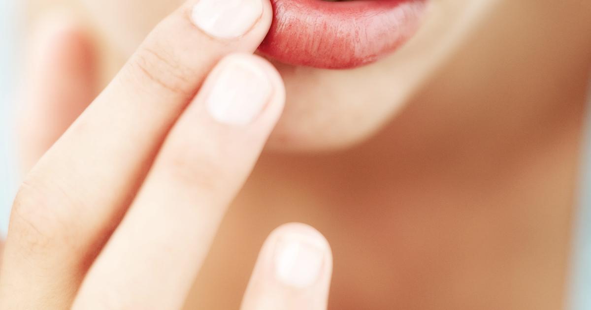 Suun ympäristön ihottuma eli perioraalidermatiitti