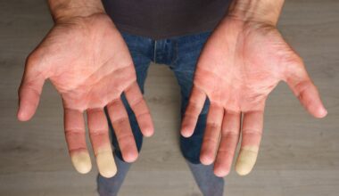 Kudokset kovettuvat – harvinainen sairaus voi vaikuttaa koko kehoon