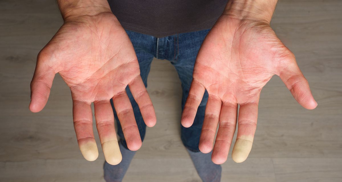 Kudokset kovettuvat – harvinainen sairaus voi vaikuttaa koko kehoon