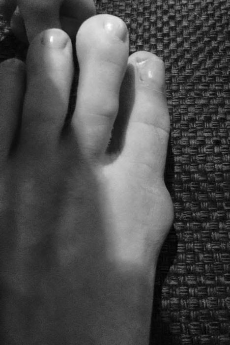 Kärry, jonka kyydissä oli 600-kiloinen juomalava, murskasi Jenni Hyypän jalkaterän.