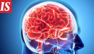 Aivoinfarktia enteilevä oire iski lähijunassa – tunnista TIA-kohtauksen oireet