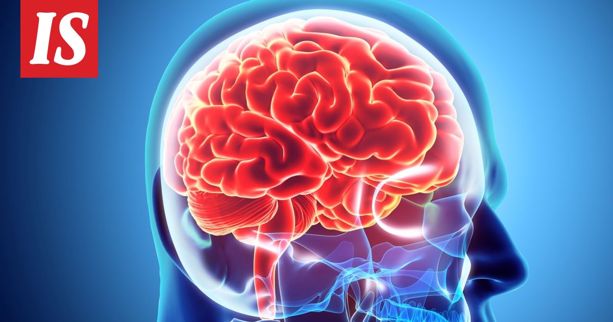 Aivoinfarktia enteilevä oire iski lähijunassa – tunnista TIA-kohtauksen oireet