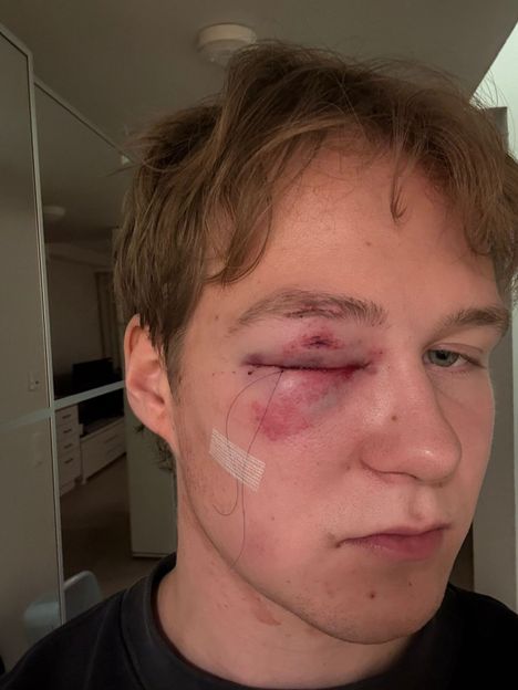 Eemeli Tykkyläisen oikea silmä on muurautunut umpeen.