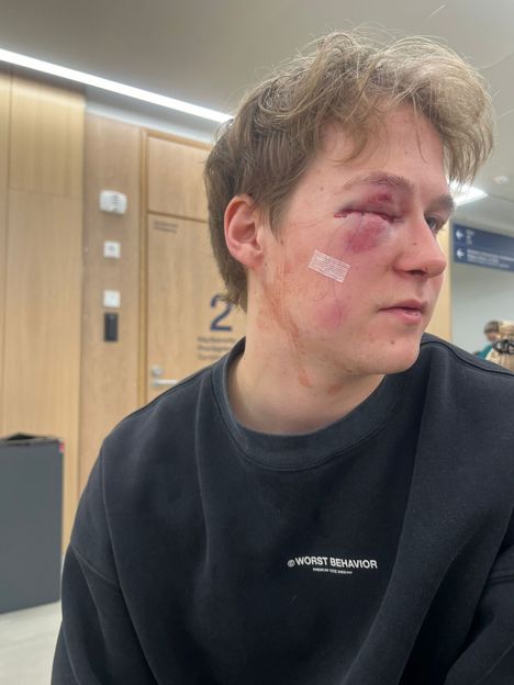 Eemeli Tykkyläinen saattaa joutua vielä leikattavaksi.