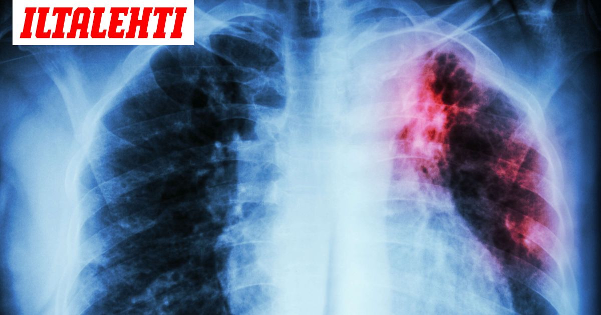 Vakavaa tautia Sipoossa – Kymmeniä altistunut