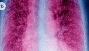 Keuhkofibroosia sairastavien määrä kasvaa Suomessa, mutta lääkärin mukaan se on hyvä asia