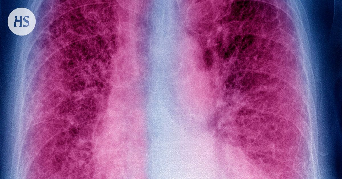 Keuhkofibroosia sairastavien määrä kasvaa Suomessa, mutta lääkärin mukaan se on hyvä asia