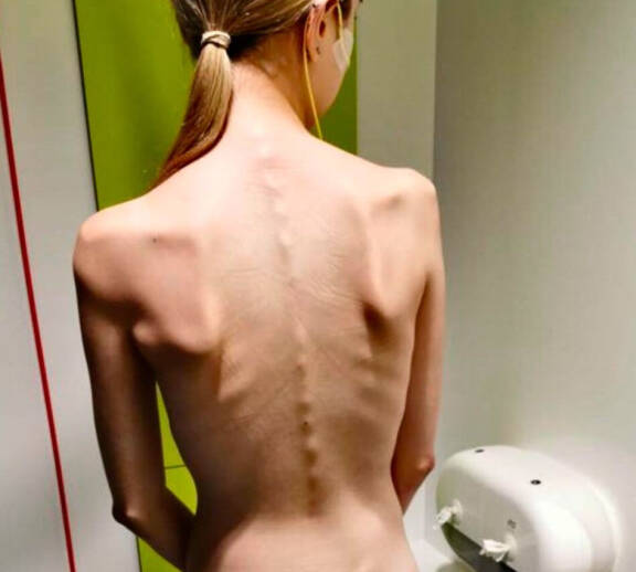 Lucyn laihuus ei johtunut anoreksiasta tai bulimiasta.