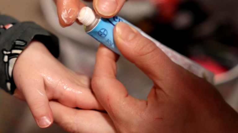 Aikuinen laittaa voidetta lapsen kädelle.