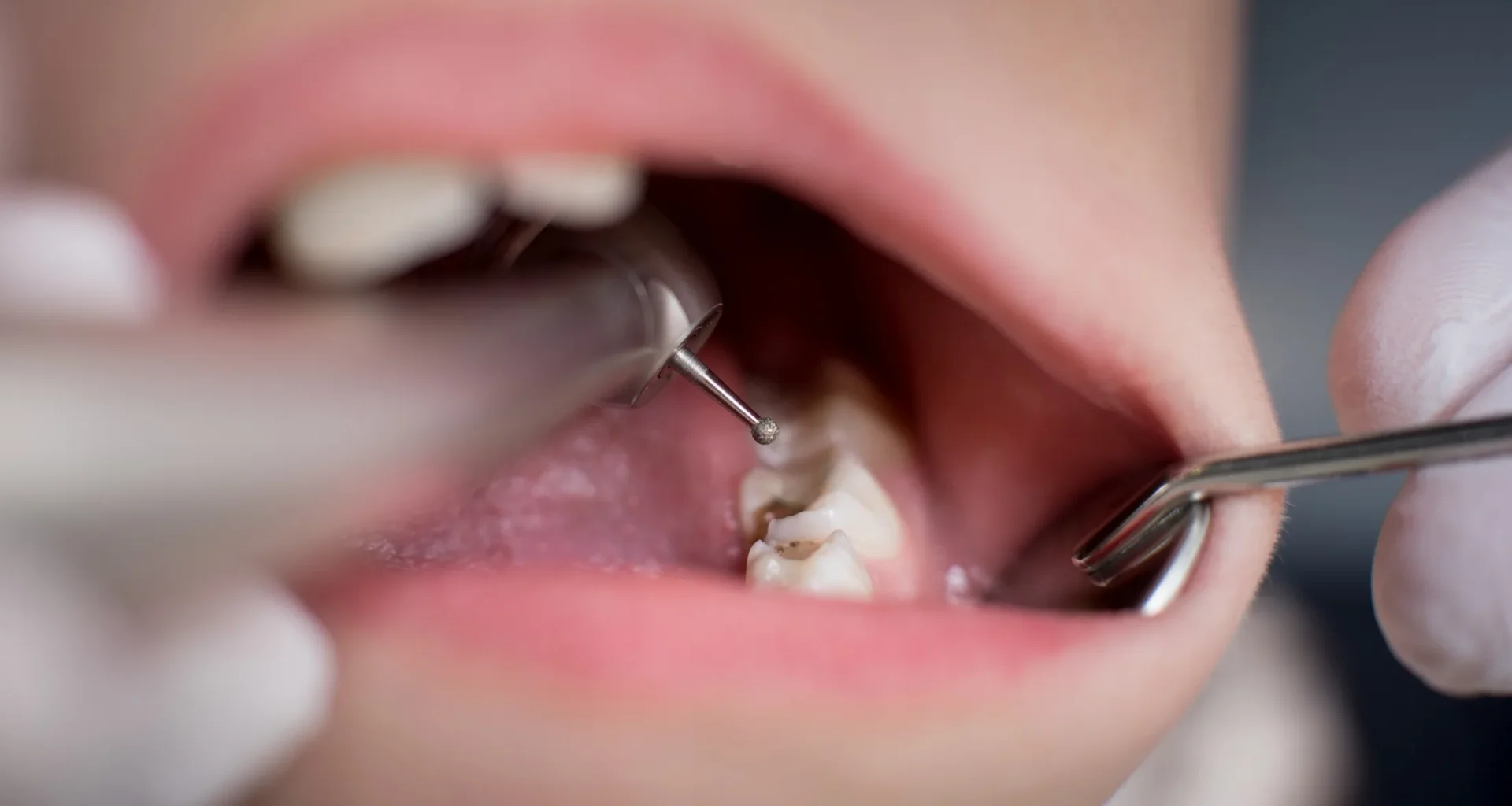 Äidin raskausajan D-vitamiinitason ja lapsen hammasterveyden väliltä löytyi yhteys