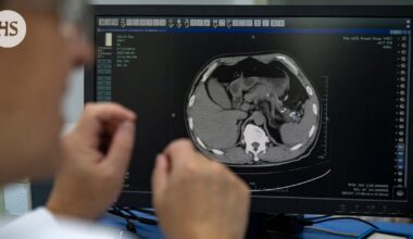 Kiinalaiset kehittivät tekoälyn, joka löytää salakavalan haimasyövän