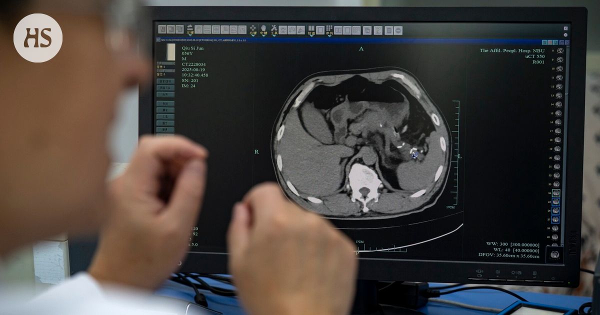 Kiinalaiset kehittivät tekoälyn, joka löytää salakavalan haimasyövän