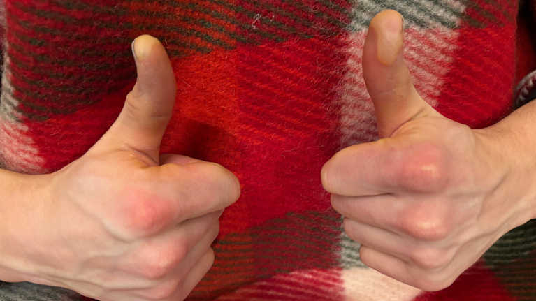 Paleltuneissa sormissa näkyy isoja vesikelloja.