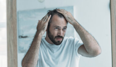 Vihdoin saattoi ratketa, miten kaljuuntuminen voidaan estää