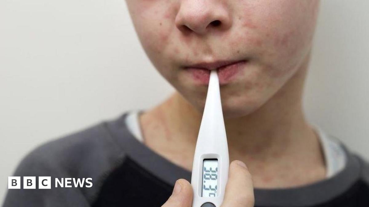 UK loses measles elimination status