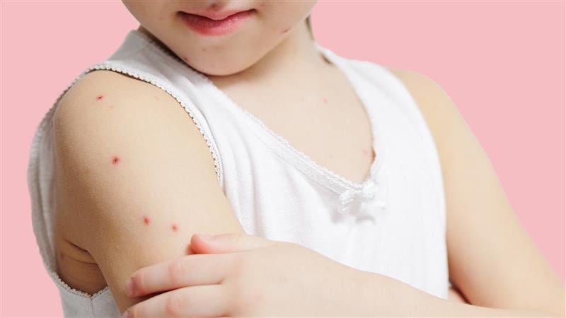 Gratis vaccine mod skoldkopper kan være på vej: Ikke ubetinget en god ide, mener eksperter