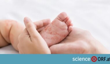 WHO: Österreich offiziell nicht mehr „masernfrei“