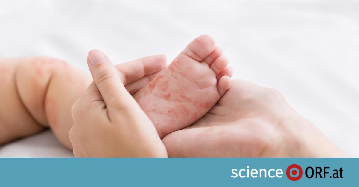 WHO: Österreich offiziell nicht mehr „masernfrei“