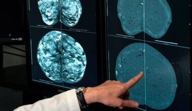 Le risque de cancer du sein plus élevé chez les femmes ayant fait plus d’études