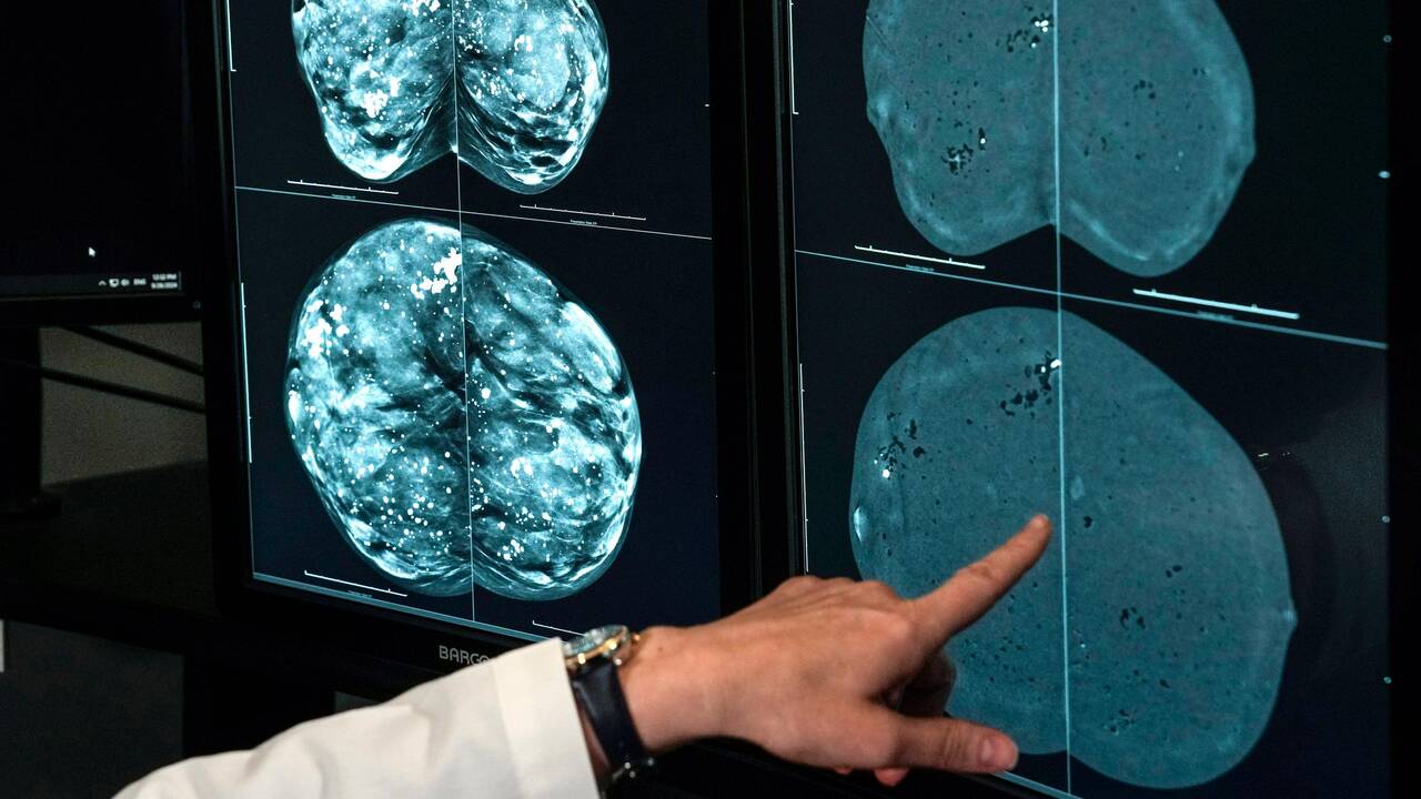 Le risque de cancer du sein plus élevé chez les femmes ayant fait plus d’études