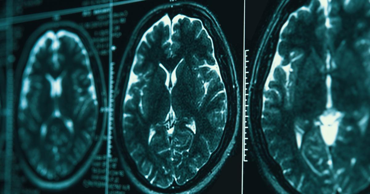 pour soigner la maladie de Parkinson, une piste se précise