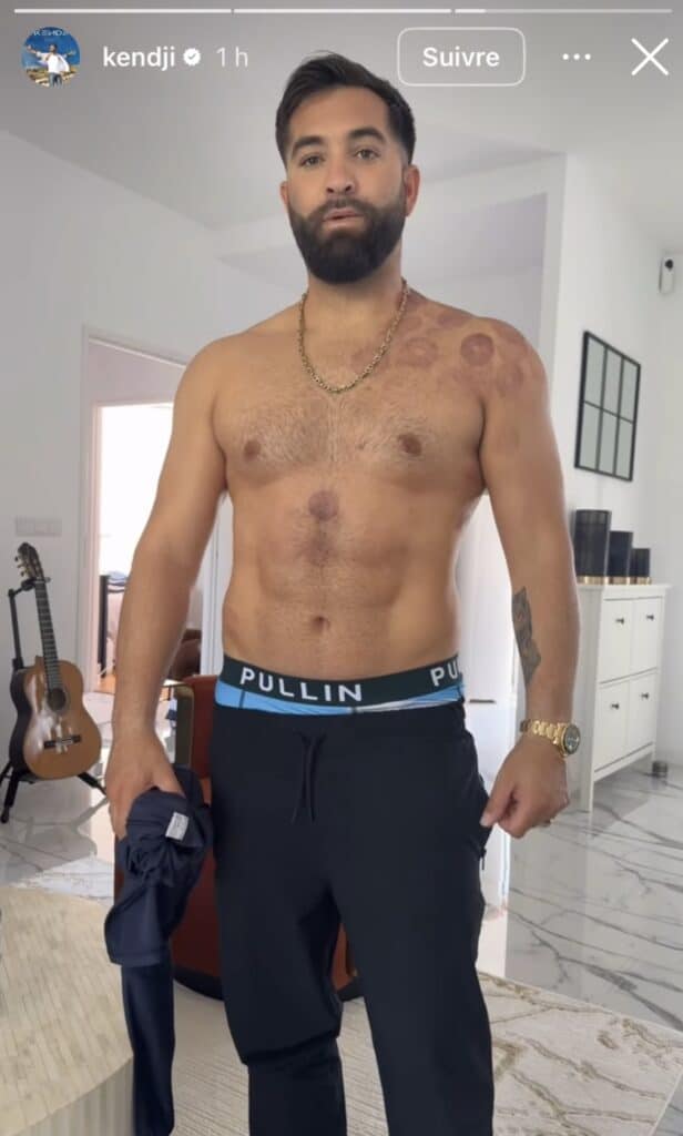 Kendji dévoile son nouveau corps musclé recouvert de nombreuses "tâches" : mais que lui est-il arrivé ?