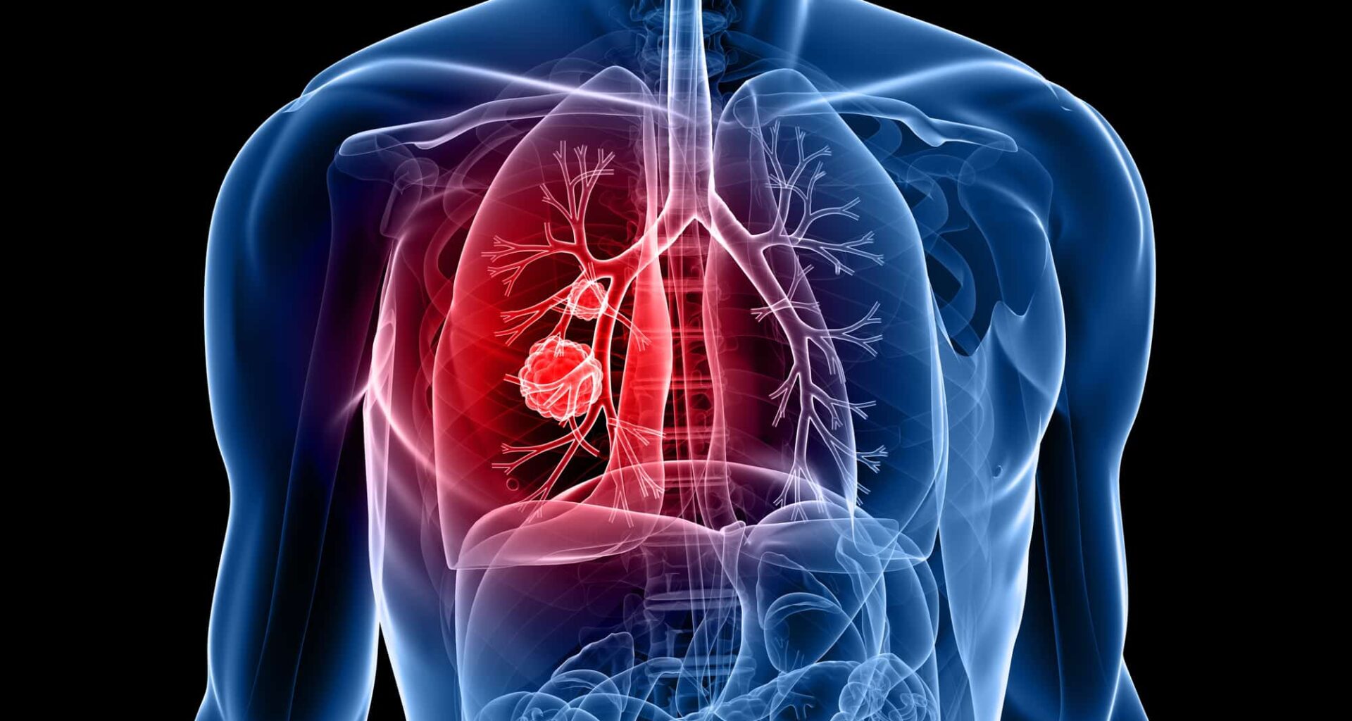 alimentation cancer poumon lien