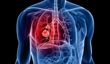 alimentation cancer poumon lien