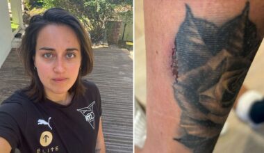 elle finit brûlée au second degré